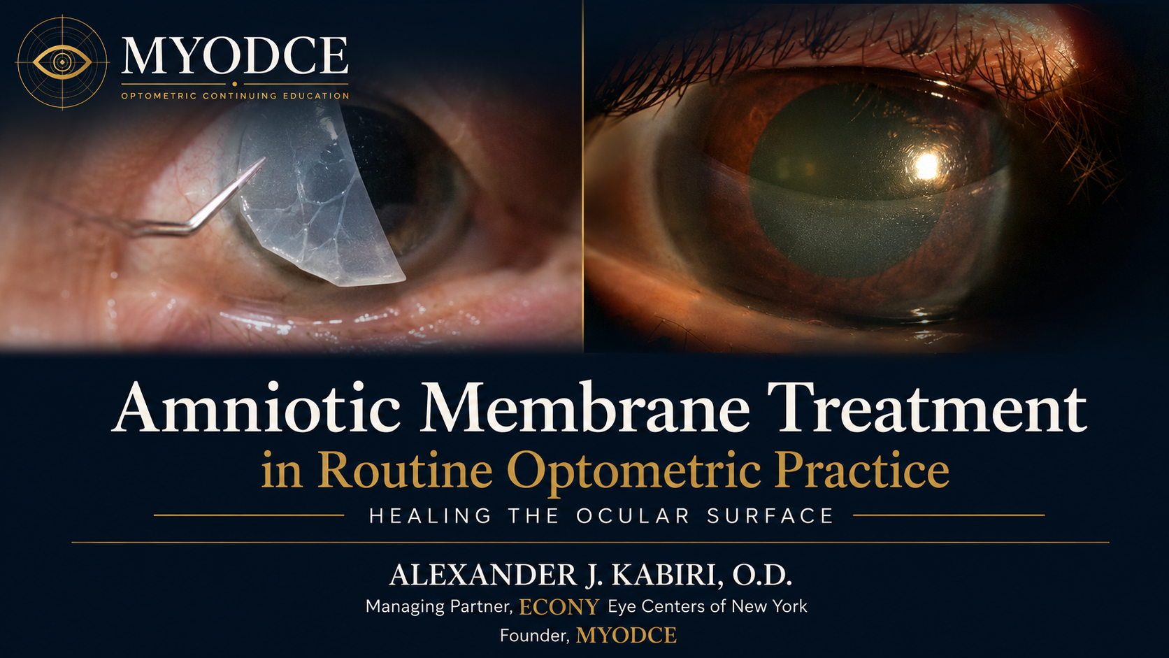 Amniotic Membrane Treatment in Routine Optometric Practice course thumbnail